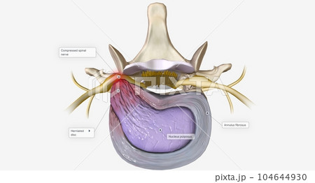A herniated disc is a condition characterized by structural changes to an intervertebral disc 104644930