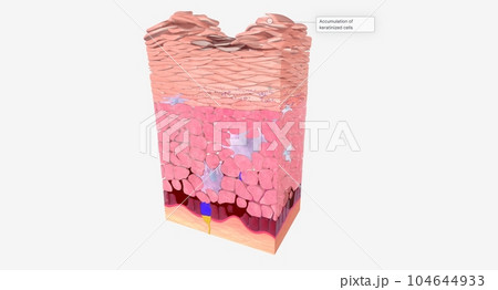 The Accumulation of keratinized cells The Accumulation of keratinized cells 104644933