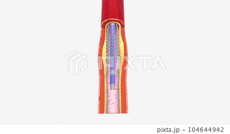 Fat layer accumulating in arteries Fat layer accumulating in arteries 104644942