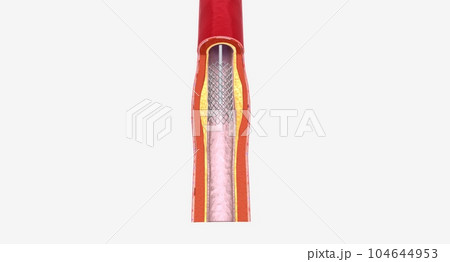 Fat layer accumulating in arteries Fat layer accumulating in arteries 104644953