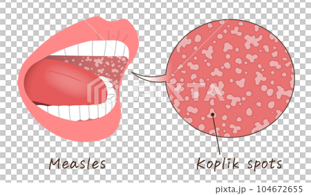 tongue,koplik spots,measles,illustration - Stock Illustration ...