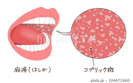 麻疹・はしか・口内の水ぶくれ・コプリック斑のイラスト 104672660