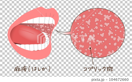 麻疹・はしか・口内の水ぶくれ・コプリック斑のイラスト 104672660