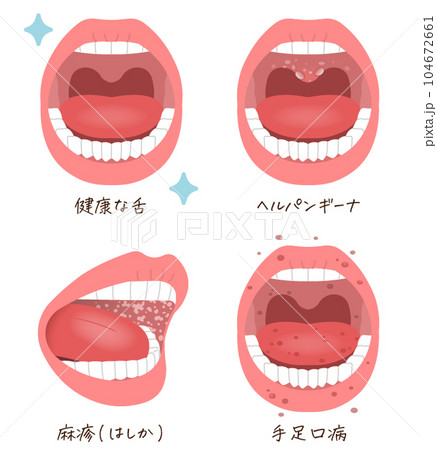舌のトラブル・疾患のイラスト・麻疹・ヘルパンギーナ・手足口病 104672661