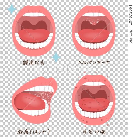 舌頭問題、疾病、麻疹、皰疹性咽峽炎、手足口病的插圖 104672661