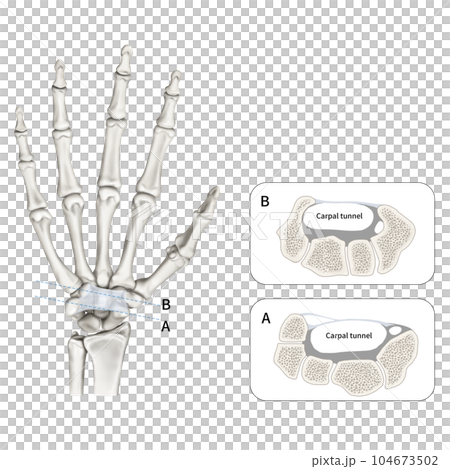 Medical illustration explaining carpal tunnel 104673502
