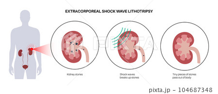Lithotripsy procedure concept Lithotripsy procedure concept 104687348