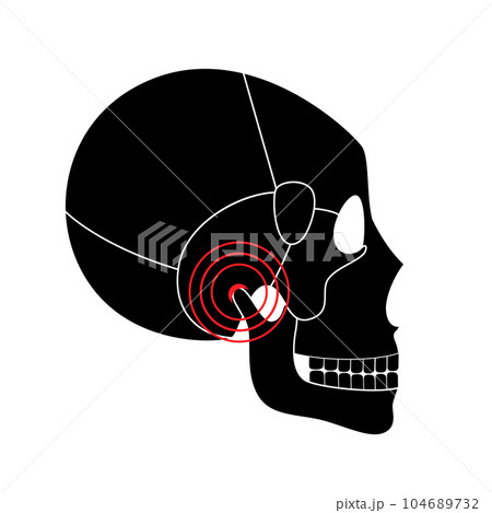 TMD TMJ disorder TMD TMJ disorder 104689732