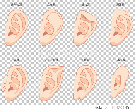 Ear deformation Ear formation medical care 104706456