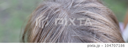 Drops of water or dandruff on childs hair 104707186