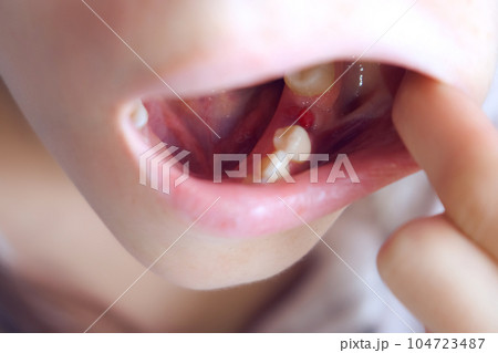Woman is looking on her removed sixth tooth with an inflamed gum. 104723487