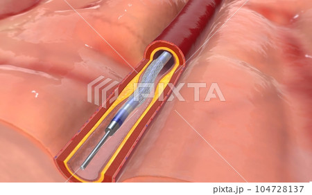 If the artery occlusion is in the brain, the surgery is called i 104728137