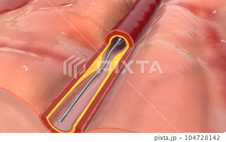 If the artery occlusion is in the brain, the surgery is called i 104728142