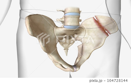 Pelvic fractures are classified as stable or unstable 104728144