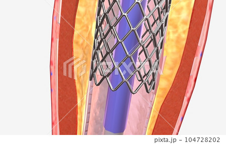 The balloon expends, widening the wire mesh stent and the artery 104728202