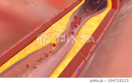 Fat deposits within the artery can build up at the injury site a Fat deposits within the artery can build up at the injury site a 104728223