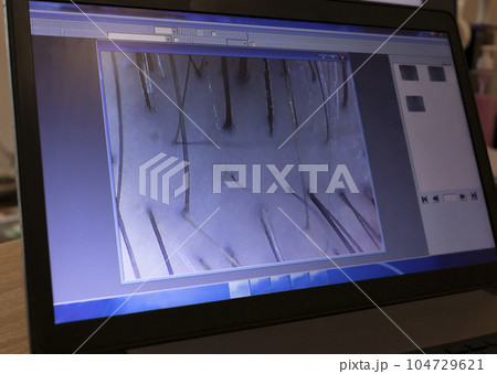 Compute Screen With Trichoscopy. Diagnosing Of Hair, Scalp Evaluation, Diseases. Closeup Hair Shaft Under Microscope, Horizontal.Hair Loss,Scalp Problem. Examination Beauty Procedure.Selective Focus Compute Screen With Trichoscopy. Diagnosing Of Hair, Scalp Evaluation, Diseases. Closeup Hair Shaft Under Microscope, Horizontal.Hair Loss,Scalp Problem. Examination Beauty Procedure.Selective Focus 104729621