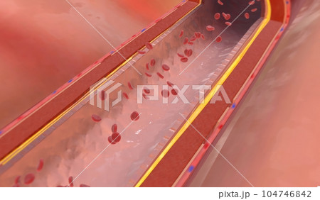 Fat deposits within the artery can build up at the injury site a 104746842