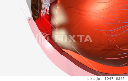 Pars planitis is an eye disease where the middle layer of the eye, called the uvea, becomes inflamed 104746843