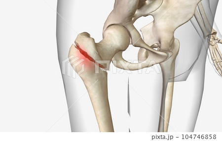 A pertrochanteric fracture is a hip fracture that is found in the trochanteric region of the femur 104746858