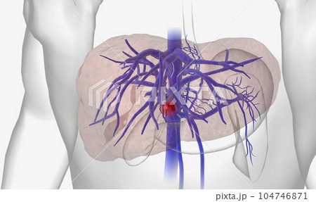 Portal vein thrombosis (PVT) is the occlusion of the portal vein by a blood clot (thrombus) Portal vein thrombosis (PVT) is the occlusion of the portal vein by a blood clot (thrombus) 104746871