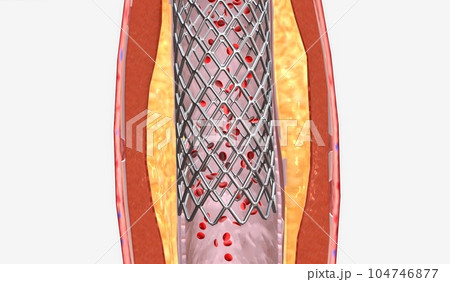 Stent insertion into artery narrowed from plaque Stent insertion into artery narrowed from plaque 104746877