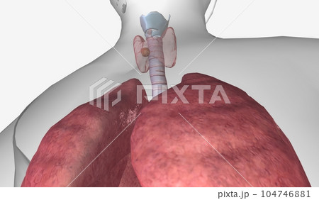 In stage II thyroid cancer, the tumor is between 2 and 4 cm acro 104746881