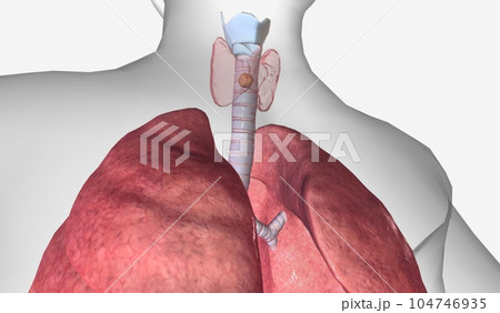 In stage II thyroid cancer, the tumor is between 2 and 4 cm acro In stage II thyroid cancer, the tumor is between 2 and 4 cm acro 104746935
