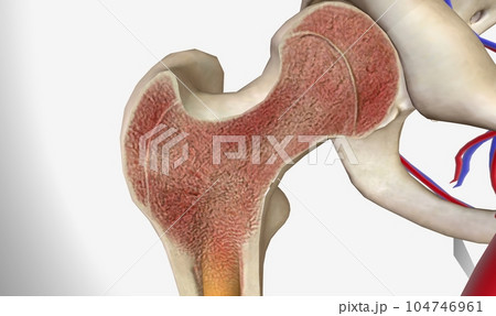 The Multiple Myeloma Bone Marrow 104746961