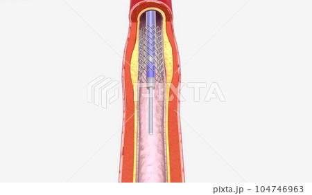 Stent insertion into artery narrowed from plaque 104746963