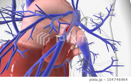 A pulmonary embolism is a sudden blockage in your pulmonary arteries, the blood vessels that send blood to your lungs 104746964