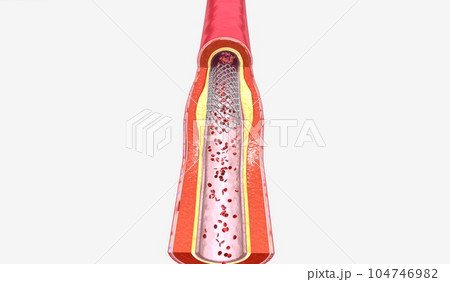 Stent insertion into artery narrowed from plaque 104746982