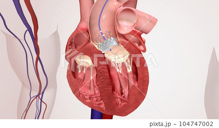 Valve insertion into damaged heart valve 104747002