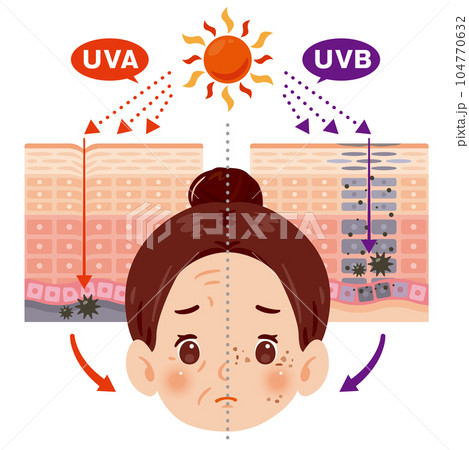 紫外線によるシミとシワのイラスト素材 [104770632] - Pixta