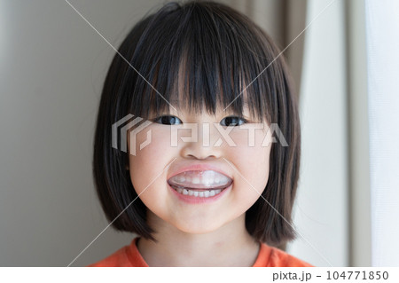 反対咬合用マウスピースをつける5歳の子供 反対咬合用マウスピースをつける5歳の子供 104771850