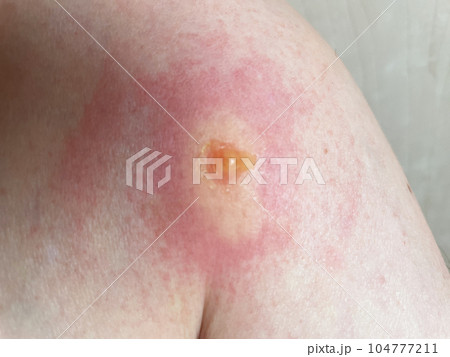 蚊に刺されて水膨れ 104777211