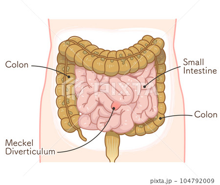Diverticulum・ meckel diverticulum・small intestine Diverticulum・ meckel diverticulum・small intestine 104792009