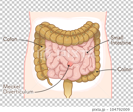 Diverticulum・ meckel diverticulum・small intestine Diverticulum・ meckel diverticulum・small intestine 104792009