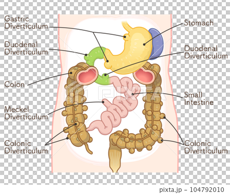 憩室、梅克爾憩室、小腸 憩室、梅克爾憩室、小腸 104792010