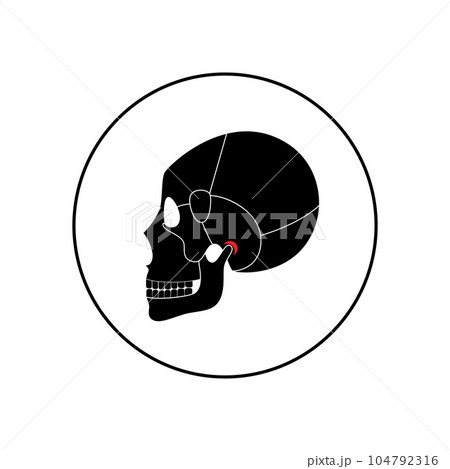 TMD TMJ disorder 104792316