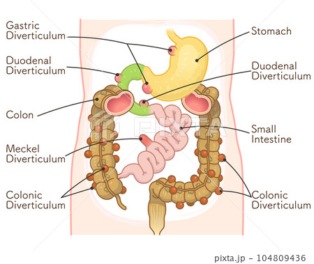 Diverticulum・ meckel diverticulum・small intestine 104809436