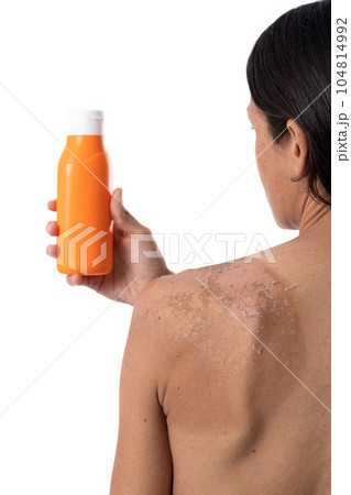 Back of woman with sunburn holding sunscreen bottle. Isolated on white background with copy space. Vertical format 104814992