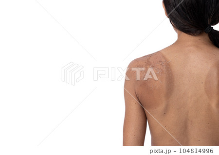 Adult woman with sunburn on her back, isolated on white background with copy space. 104814996