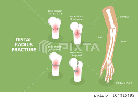3D Isometric Flat Vector Conceptual Illustration of Distal Radius Fracture 3D Isometric Flat Vector Conceptual Illustration of Distal Radius Fracture 104815495