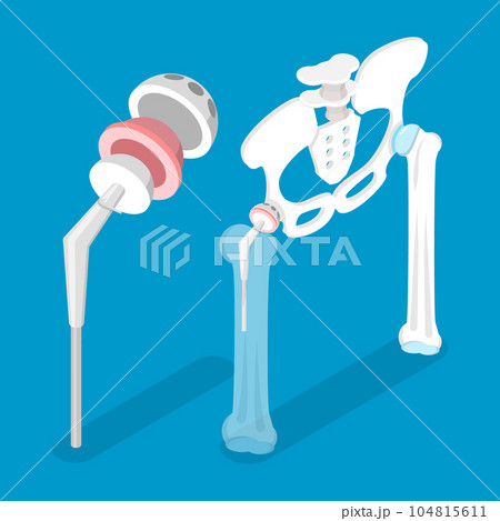 3D Isometric Flat Vector Conceptual Illustration of Total Hip Replacement 104815611