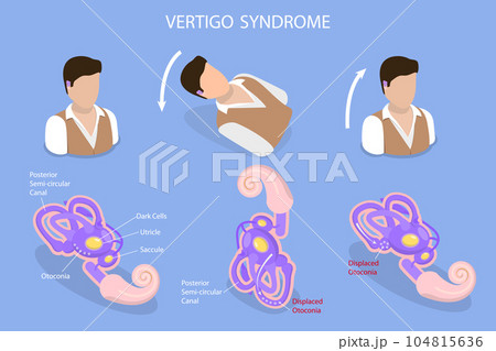 3D Isometric Flat Vector Conceptual Illustration of Vertigo Syndrome 3D Isometric Flat Vector Conceptual Illustration of Vertigo Syndrome 104815636