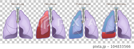 肺、氣管、氣胸、血胸、血氣胸的插圖 肺、氣管、氣胸、血胸、血氣胸的插圖 104833566