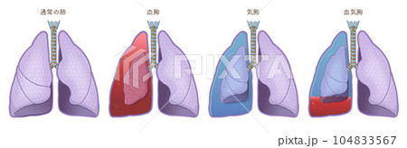 lungs,hemothorax,pneumothorax,hemopneumothorax lungs,hemothorax,pneumothorax,hemopneumothorax 104833567