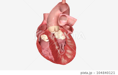 Removes excess heart muscle tissue, improves blood flow Removes excess heart muscle tissue, improves blood flow 104840121
