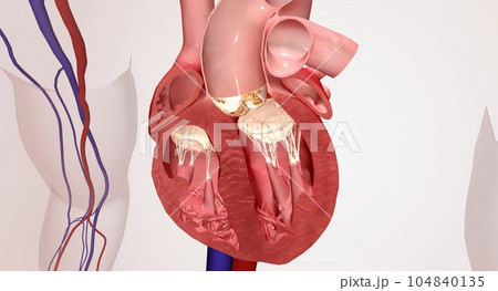 Valve insertion into damaged heart valve 104840135